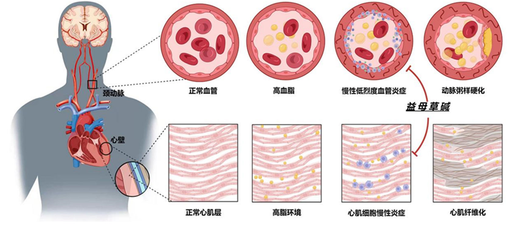 臨床研究表明硫酸益母草堿 (SCM-198) 對慢性低烈度血管炎症效果顯著